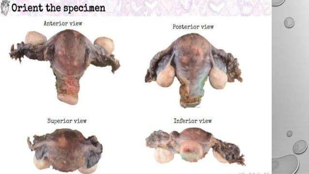 Histopath Grossing of uterus cervix &ovary