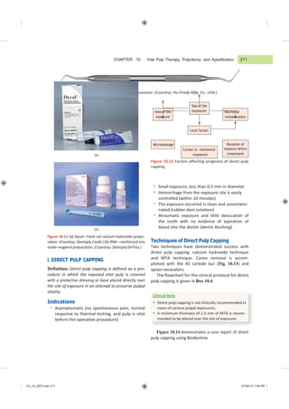 Ch_10_GEP.indd 211 07/08/14 7:46 PM
Area of the
exposure
Local factors
Bacterial
contamination
Size of the
exposure
Microleakage
Carious vs. mechanical
exposure
Duration of
exposure before
treatment
Clinical Note
 Direct pulp capping is not clinically recommended in
cases of carious pulpal exposures.
 A minimum thickness of 1.5 mm of MTA is recom−
mended to be placed over the site of exposure.
CHAPTER 10 Vital Pulp Therapy, Pulpotomy, and Apexification
Figure 10.10 Endodontic spoon excavator. (Courtesy: Hu-Friedy Mfg. Co., USA.)
(a)
(b)
Figure 10.11 (a) Dycal—hard−set calcium hydroxide prepa−
ration. (Courtesy: Dentsply Caulk.) (b) IRM—reinforced zinc
oxide−eugenol preparation. (Courtesy: Dentsply DeTrey.)
I. DIRECT PULP CAPPING
Definition: Direct pulp capping is defined as a pro-
cedure in which the exposed vital pulp is covered
with a protective dressing or base placed directly over
the site of exposure in an attempt to preserve pulpal
vitality.
Indications
 Asymptomatic (no spontaneous pain, normal
response to thermal testing, and pulp is vital
before the operative procedure)
Figure 10.12 Factors affecting prognosis of direct pulp
capping.
 Small exposure, less than 0.5 mm in diameter
 Hemorrhage from the exposure site is easily
controlled (within 10 minutes)
 The exposure occurred is clean and uncontami-
nated (rubber dam isolation)
 Atraumatic exposure and little desiccation of
the tooth with no evidence of aspiration of
blood into the dentin (dentin blushing)
Techniques of Direct Pulp Capping
Two techniques have demonstrated success with
direct pulp capping: calcium hydroxide technique
and MTA technique. Caries removal is accom-
plished with the #2 carbide bur (Fig. 10.13) and
spoon excavators.
The flowchart for the clinical protocol for direct
pulp capping is given in Box 10.4.
Figure 10.14 demonstrates a case report of direct
pulp capping using Biodentine.
211
 