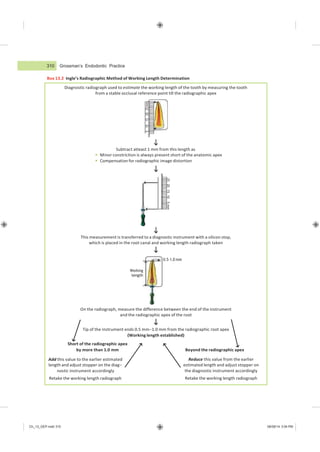 310 Grossman’s Endodontic Practice
Ch_13_GEP.indd 310 08/08/14 3:04 PM
Diagnostic radiograph used to estimate the working length of the tooth by measuring the tooth
from a stable occlusal reference point till the radiographic apex
Working
length
0.5–1.0 mm
Add this value to the earlier estimated
length and adjust stopper on the diag−
nostic instrument accordingly
Retake the working length radiograph
Reduce this value from the earlier
estimated length and adjust stopper on
the diagnostic instrument accordingly
Retake the working length radiograph
Box 13.2 Ingle’s Radiographic Method of Working Length Determination
On the radiograph, measure the difference between the end of the instrument
and the radiographic apex of the root
Tip of the instrument ends 0.5 mm−1.0 mm from the radiographic root apex
(Working length established)
Short of the radiographic apex
by more than 1.0 mm Beyond the radiographic apex
This measurement is transferred to a diagnostic instrument with a silicon stop,
which is placed in the root canal and working length radiograph taken
Subtract atleast 1 mm from this length as
 Minor constriction is always present short of the anatomic apex
 Compensation for radiographic image distortion
25
20
15
10
5
mm
5
10
15
20
25
mm
 