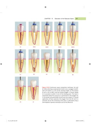 Ch_15_GEP.indd 357 08/08/14 5:09 PM
CHAPTER 15 Obturation of the Radicular Space
(a) (b)(i) (b)(ii) (b)(iii) (b)(iv)
(c) (d) (e) (f) (g)
(h) (i)
Figure 15.14 Continuous wave compaction technique. (a) and
(b) After selecting an appropriate master cone, a plugger is prefit-
ted to fit within 5−7 mm of the working length. (c) The System
B unit is set to 200°C and the heated plugger is moved rapidly
(1–2 seconds) to within 3 mm of the binding point. The heat is
inactivated while firm pressure is maintained on the plugger for
5−10 seconds. (d) and (e) After the GP mass has cooled, a 1−second
application of heat separates the plugger from the GP and it is
removed. (f)–(i) The remaining canal space is obturated using a
thermoplastic injection technique such as the Obtura III.
357
 