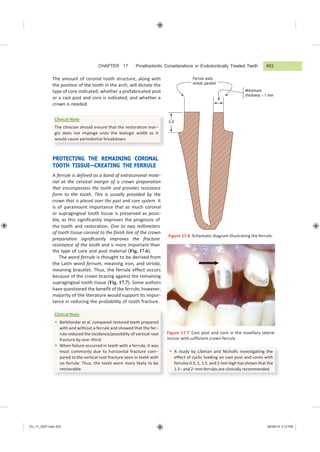 CHAPTER 17 Prosthodontic Considerations in Endodontically Treated Teeth 403
Ch_17_GEP.indd 403 08/08/14 3:12 PM
The amount of coronal tooth structure, along with
the position of the tooth in the arch, will dictate the
type of core indicated; whether a prefabricated post
or a cast post and core is indicated; and whether a
crown is needed.
PROTECTING THE REMAINING CORONAL
TOOTH TISSUE—CREATING THE FERRULE
A ferrule is defined as a band of extracoronal mate-
rial at the cervical margin of a crown preparation
that encompassess the tooth and provides resistance
form to the tooth. This is usually provided by the
crown that is placed over the post and core system. It
is of paramount importance that as much coronal
or supragingival tooth tissue is preserved as possi-
ble, as this significantly improves the prognosis of
the tooth and restoration. One to two millimeters
of tooth tissue coronal to the finish line of the crown
preparation significantly improves the fracture
Minimum
thickness  1 mm
Figure 17.6 Schematic diagram illustrating the ferrule.
resistance of the tooth and is more important than
the type of core and post material (Fig. 17.6).
The word ferrule is thought to be derived from
the Latin word ferrum, meaning iron, and viriola,
meaning bracelet. Thus, the ferrule effect occurs
because of the crown bracing against the remaining
supragingival tooth tissue (Fig. 17.7). Some authors
have questioned the benefit of the ferrule; however,
majority of the literature would support its impor-
tance in reducing the probability of tooth fracture.
Figure 17.7 Cast post and core in the maxillary lateral
incisor with sufficient crown ferrule.
 A study by Libman and Nicholls investigating the
effect of cyclic loading on cast post and cores with
ferrules 0.5, 1, 1.5, and 2 mm high has shown that the
1.5− and 2−mm ferrules are clinically recommended.
Clinical Note
 Barkhordar et al. compared restored teeth prepared
with and without a ferrule and showed that the fer−
rule reduced the incidence/possibility of vertical root
fracture by one−third.
 When failure occurred in teeth with a ferrule, it was
most commonly due to horizontal fracture com−
pared to the vertical root fracture seen in teeth with
no ferrule. Thus, the teeth were more likely to be
retrievable.
Clinical Note
The clinician should ensure that the restoration mar−
gin does not impinge onto the biologic width as it
would cause periodontal breakdown.
Ferrule walls
almost parallel
2.0
 