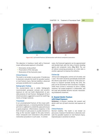 Ch_18_GEP.indd 425 08/08/14 2:59 PM
CHAPTER 18 Treatment of Traumatized Teeth
(a) (b)
Figure 18.2 (a) Enamel fracture. (b) Restoration with direct composite restoration.
The objective in treating a tooth with a fractured
crown without pulp exposure is threefold:
 Elimination of discomfort
 Preservation of the vital pulp
 Restoration of the fractured crown
Clinical Features
The tooth is not tender on percussion. If tenderness
is observed, evaluate the tooth for possible luxation
or root fracture injury. Normal mobility is observed
and pulp sensibility test is usually positive.
Radiographic Findings
The enamel–dentin loss is visible. Radiographs
recommended: periapical, occlusal, and eccentric
exposure to rule out tooth displacement or pos-
sible presence of root fracture. Radiograph of lip or
cheek lacerations suggested to search for tooth frag-
ments or foreign materials.
Treatment
In an uncomplicated fracture of the crown with-
out pulpal exposure, a remaining dentinal thickness
of 2 mm is sufficient to shield the pulp and ensure
a good prognosis. Inflammatory response in the
form of pain on percussion is usually transient as
long as the vascular supply to the pulp remains
intact. Composite resin restoration is the preferred
restorative procedure in such cases. In certain
cases, the fractured segments can be approximated
and bonded back with the help of dentin bonding
agents and composite resins (Fig. 18.3). The use
of indirect veneering procedures at a later date is
another approach to improve the esthetics.
Follow-Up
Clinical and radiographic control at 6–8 weeks and
1 year. The tooth should be periodically tested with
the electric pulp tester or Endo Ice. If the pulp con-
tinues to respond normally during this time, the
pulp can be assumed to have recovered. If progres-
sively more current is necessary to elicit a vitality
response, the pulpal prognosis is unfavorable, and
the pulp will probably become necrotic necessitat-
ing endodontic treatment.
D. Enamel–Dentin Fracture
with Pulpal Exposure
Definition: A fracture involving the enamel and
dentin with loss of tooth structure and exposure of
pulp.
Clinical Features
Normal mobility. The tooth is not tender on
percussion, however if tenderness is observed, eval-
uate for possible luxation or root fracture injury.
Exposed pulp is sensitive to stimuli.
425
 
