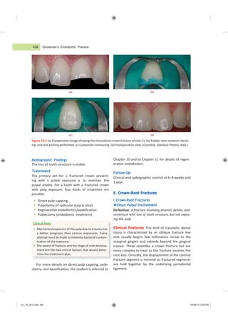 Ch_18_GEP.indd 426 08/08/14 2:59 PM
Grossman’s Endodontic Practice
(a) (b)
(c) (d)
Figure 18.3 (a) Preoperative image showing the mesiodistal crown fracture of vital 21. (b) Rubber dam isolation, bevel-
ing, and acid etching performed. (c) Composite contouring. (d) Postoperative view. (Courtesy: Gianluca Plotino, Italy.)
Radiographic Findings
The loss of tooth structure is visible.
Treatment
The primary aim for a fractured crown present-
ing with a pulpal exposure is to maintain the
pulpal vitality. For a tooth with a fractured crown
with pulp exposure, four kinds of treatment are
possible:
 Direct pulp capping
 Pulpotomy (if radicular pulp is vital)
 Regenerative endodontics/apexification
 Pulpectomy (endodontic treatment)
For more details on direct pulp capping, pulp-
otomy, and apexification, the student is referred to
Chapter 10 and to Chapter 11 for details of regen-
erative endodontics.
Follow-Up
Clinical and radiographic control at 6–8 weeks and
1 year.
E. Crown–Root Fractures
i. Crown–Root Fractures
Without Pulpal Involvement
Definition: A fracture involving enamel, dentin, and
cementum with loss of tooth structure, but not expos-
ing the pulp.
Clinical Features This kind of traumatic dental
injury is characterized by an oblique fracture line
that usually begins few millimeters incisal to the
marginal gingiva and extends beyond the gingival
crevice. These resemble a crown fracture but are
more complex to treat as the fracture involves the
root also. Clinically, the displacement of the coronal
fracture segment is minimal as fractured segments
are held together by the underlying periodontal
ligament.
426
Clinical Note
 Mechanical exposure of the pulp due to trauma has
a better prognosis than carious exposures. Every
attempt must be made to minimize bacterial contam-
ination of the exposure.
 The extent of fracture and the stage of root develop-
ment are the two critical factors that would deter-
mine the treatment plan.
 