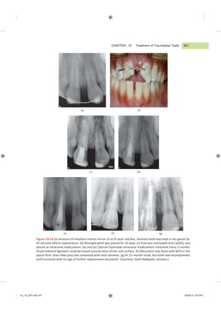 Ch_18_GEP.indd 441 08/08/14 3:00 PM
CHAPTER 18 Treatment of Traumatized Teeth
(a) (b)
(c) (d)
(e) (f) (g)
Figure 18.13 (a) Avulsion of maxillary central incisor of an 8−year−old boy. Avulsed tooth was kept in dry gauze for
45 minutes before replantation. (b) Nonrigid splint was placed for 10 days. (c) Pulp was extirpated and Ca(OH)2 was
placed as intracanal medicament. (d) and (e) Calcium hydroxide intracanal medicament refreshed every 3 months
till periodontal ligament could be traced around most of the root surface. (f) Obturation was done with MTA in the
apical third. Glass fiber post was cemented with resin ionomer. (g) At 15−month recall, the tooth was asymptomatic
and functional with no sign of further replacement resorption. (Courtesy: Sashi Nallapati, Jamaica.)
441
 