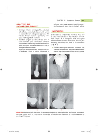 Ch_20_GEP.indd 463 08/08/14 11:40 AM
OBJECTIVES AND
RATIONALE FOR SURGERY
 Curettage: Effective curettage of the pathologi-
cally affected periradicular tissue which cannot
be accessed in an orthograde approach. This
includes therapy-resistant granuloma, true
cysts, and foreign body reactions.
 Resection: Surgical resection of root apex in
cases where the apical ramifications cannot be
eliminated in a nonsurgical endodontic treat-
ment or surgical resection of a root in cases of
poor periodontal support.
 Inspection: Inspection of the periradicular area
to ascertain causes of failure, inspection of
CHAPTER 20 Endodontic Surgery
isthmus, and trace accessory canals in nonsur-
gical endodontic cases that are clinically failing.
INDICATIONS
Evidence-based endodontic literature has led
to substantial reduction in the indications for root-
end surgery. It is recognized that nonsurgical
treatment is the choice in most cases. However, the
following indications may have to be considered
(Fig. 20.1):
 Failure of nonsurgical endodontic treatment: Per-
sistence of symptoms in teeth in which radio-
graphically adequate nonsurgical endodontic
(a) (b)
(c) (d)
Figure 20.1 Cases illustrating indications for endodontic surgery: (a) and (b) Persistent periradicular pathology in
root canal−treated teeth. (c) Perforation of the root due to improper post placement. (d) Persistent pain due to
overfilling of the canals.
463
 