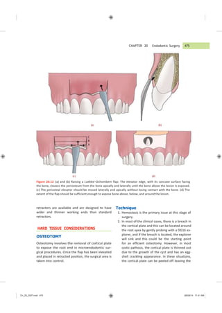 CHAPTER 20 Endodontic Surgery 475
Ch_20_GEP.indd 475 08/08/14 11:41 AM
C
B
A
(a) (b)
(c) (d)
Figure 20.12 (a) and (b) Raising a Luebke−Ochsenbein flap: The elevator edge, with its concave surface facing
the bone, cleaves the periosteum from the bone apically and laterally until the bone above the lesion is exposed.
(c) The periosteal elevator should be moved laterally and apically without losing contact with the bone. (d) The
extent of the flap should be sufficient enough to expose bone above, below, and around the lesion.
retractors are available and are designed to have
wider and thinner working ends than standard
retractors.
HARD TISSUE CONSIDERATIONS
OSTEOTOMY
Osteotomy involves the removal of cortical plate
to expose the root end in microendodontic sur-
gical procedures. Once the flap has been elevated
and placed in retracted position, the surgical area is
taken into control.
Technique
1. Hemostasis is the primary issue at this stage of
surgery.
2. In most of the clinical cases, there is a breach in
the cortical plate and this can be located around
the root apex by gently probing with a DG16 ex-
plorer, and if the breach is located, the explorer
will sink and this could be the starting point
for an efficient osteotomy. However, in most
cystic pathosis, the cortical plate is thinned out
due to the growth of the cyst and has an egg-
shell crackling appearance. In these situations,
the cortical plate can be peeled off leaving the
 