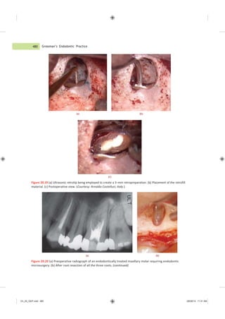 Ch_20_GEP.indd 480 08/08/14 11:41 AM
Grossman’s Endodontic Practice
(a) (b)
(c)
Figure 20.19 (a) Ultrasonic retrotip being employed to create a 3−mm retropreparation. (b) Placement of the retrofill
material. (c) Postoperative view. (Courtesy: Arnaldo Castelluci, Italy.)
(a) (b)
Figure 20.20 (a) Preoperative radiograph of an endodontically treated maxillary molar requiring endodontic
microsurgery. (b) After root resection of all the three roots. (continued)
480
 
