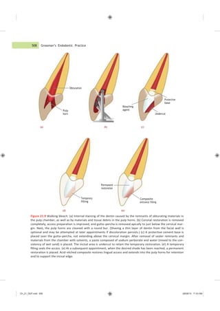 508 Grossman’s Endodontic Practice
Ch_21_GEP.indd 508 08/08/14 11:43 AM
(d) (e)
Figure 21.9 Walking bleach: (a) Internal staining of the dentin caused by the remnants of obturating materials in
the pulp chamber, as well as by materials and tissue debris in the pulp horns. (b) Coronal restoration is removed
completely, access preparation is improved, and gutta−percha is removed apically to just below the cervical mar-
gin. Next, the pulp horns are cleaned with a round bur. (Shaving a thin layer of dentin from the facial wall is
optional and may be attempted at later appointments if discoloration persists.) (c) A protective cement base is
placed over the gutta−percha, not extending above the cervical margin. After removal of sealer remnants and
materials from the chamber with solvents, a paste composed of sodium perborate and water (mixed to the con-
sistency of wet sand) is placed. The incisal area is undercut to retain the temporary restoration. (d) A temporary
filling seals the access. (e) At a subsequent appointment, when the desired shade has been reached, a permanent
restoration is placed. Acid−etched composite restores lingual access and extends into the pulp horns for retention
and to support the incisal edge.
Obturation
Protective
base
Pulp
horn
Bleaching
agent
Undercut
(a) (b) (c)
Permanent
restoration
Temporary
filling
Composite
entrance filling
 