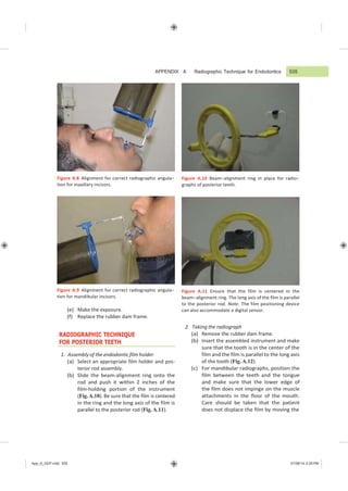APPENDIX A Radiographic Technique for Endodontics 535
App_A_GEP.indd 535 07/08/14 2:29 PM
Figure A.8 Alignment for correct radiographic angula−
tion for maxillary incisors.
Figure A.9 Alignment for correct radiographic angula−
tion for mandibular incisors.
(e) Make the exposure.
(f) Replace the rubber dam frame.
RADIOGRAPHIC TECHNIQUE
FOR POSTERIOR TEETH
1. Assembly of the endodontic film holder
(a) Select an appropriate film holder and pos-
terior rod assembly.
(b) Slide the beam-alignment ring onto the
rod and push it within 2 inches of the
film-holding portion of the instrument
(Fig.A.10). Be sure that the film is centered
in the ring and the long axis of the film is
parallel to the posterior rod (Fig. A.11).
Figure A.10 Beam−alignment ring in place for radio−
graphs of posterior teeth.
Figure A.11 Ensure that the film is centered in the
beam−alignment ring. The long axis of the film is parallel
to the posterior rod. Note. The film positioning device
can also accommodate a digital sensor.
2. Taking the radiograph
(a) Remove the rubber dam frame.
(b) Insert the assembled instrument and make
sure that the tooth is in the center of the
film and the film is parallel to the long axis
of the tooth (Fig. A.12).
(c) For mandibular radiographs, position the
film between the teeth and the tongue
and make sure that the lower edge of
the film does not impinge on the muscle
attachments in the floor of the mouth.
Care should be taken that the patient
does not displace the film by moving the
 