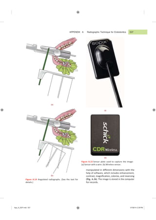 APPENDIX A Radiographic Technique for Endodontics 537
App_A_GEP.indd 537 07/08/14 2:29 PM
(a)
(b)
Figure A.14 Angulated radiographs. (See the text for
details.)
(a)
(b)
Figure A.15 Sensor plate used to capture the image:
(a) Sensor with a wire. (b) Wireless sensor.
manipulated in different dimensions with the
help of software, which includes enhancement,
contrast, magnification, colorize, and reversing
(Fig. A.16). The image is stored in the computer
for records.
 