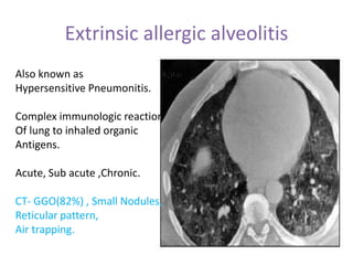 Extrinsic allergic alveolitis
Also known as
Hypersensitive Pneumonitis.
Complex immunologic reaction
Of lung to inhaled organic
Antigens.
Acute, Sub acute ,Chronic.
CT- GGO(82%) , Small Nodules,
Reticular pattern,
Air trapping.
 