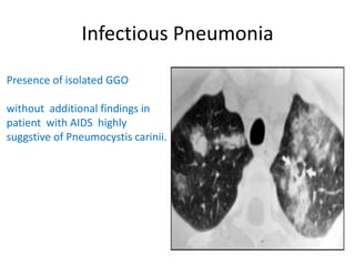Infectious Pneumonia
Presence of isolated GGO
without additional findings in
patient with AIDS highly
suggstive of Pneumocystis carinii.
 