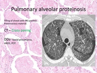 Pulmonary alveolar proteinosis
Filling of alveoli with PAS positive
Proteinacious material.
CT – Crazy paving
DDs- lipoid pneumonia,
ARDS, PCP.
 