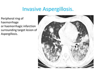 Invasive Aspergillosis.
Peripheral ring of
haemorrhage
or haemorrhagic infarction
surrounding target lesion of
Aspergillosis.
 