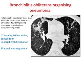 Bronchiolitis obliterans organising
pneumonia.
Histologically- granulation tissue plugs
within respiratory bronchioles and
alveolar ducts with Organising
pneumonia extending into
the surrounding alveoli.
CT –pachy GGO,nodules,
consolidtion
in peripheral distribution
Bilateral, non-segmental.
 