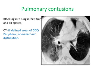 Pulmonary contusions
Bleeding into lung interstitium
and air spaces.
CT- ill defined areas of GGO,
Peripheral, non-anatomic
distribution.
 