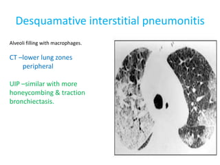 Desquamative interstitial pneumonitis
Alveoli filling with macrophages.
CT –lower lung zones
peripheral
UIP –similar with more
honeycombing & traction
bronchiectasis.
 
