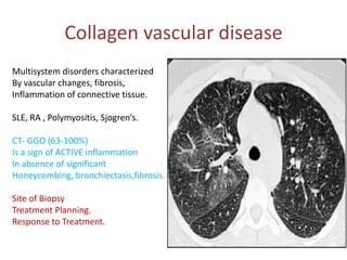 Collagen vascular disease
Multisystem disorders characterized
By vascular changes, fibrosis,
Inflammation of connective tissue.
SLE, RA , Polymyositis, Sjogren’s.
CT- GGO (63-100%)
Is a sign of ACTIVE inflammation
In absence of significant
Honeycombing, bronchiectasis,fibrosis.
Site of Biopsy
Treatment Planning.
Response to Treatment.
 