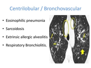 Centrilobular / Bronchovascular
• Eosinophilic pneumonia
• Sarcoidosis
• Extrinsic allergic alveolitis
• Respiratory Bronchiolitis.
 