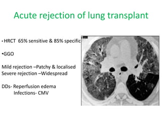 Acute rejection of lung transplant
• HRCT 65% sensitive & 85% specific
•GGO
Mild rejection –Patchy & localised
Severe rejection –Widespread
DDs- Reperfusion edema
Infections- CMV
 