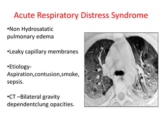Acute Respiratory Distress Syndrome
•Non Hydrosatatic
pulmonary edema
•Leaky capillary membranes
•Etiology-
Aspiration,contusion,smoke,
sepsis.
•CT –Bilateral gravity
dependentclung opacities.
 