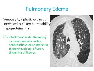 Pulmonary Edema
Venous / Lymphatic ostruction
Increased capillary permeability
Hypoproteinemia
CT- interlobular septal thickening
increased vascular calibre
peribronchovascular interstitial
thickening, pleural effusion,
thickening of fissures.
 