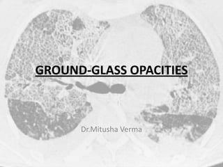 GROUND-GLASS OPACITIES
Dr.Mitusha Verma
 