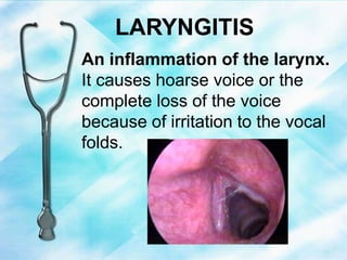 LARYNGITIS
An inflammation of the larynx.
It causes hoarse voice or the
complete loss of the voice
because of irritation to the vocal
folds.
 