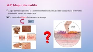 4.9 Atopic dermatitis
Atopic dermatitis (eczema) is a common inflammatory skin disorder characterized by recurrent
eczematous lesions and intense itch.
It's common in children but can occur at any age.
20%
 