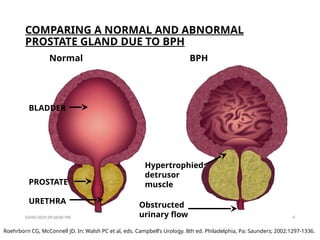 Obstructed Prostate GROUP 14 PHARMACOLOGY PRESENTATION SLIDES.pptx
