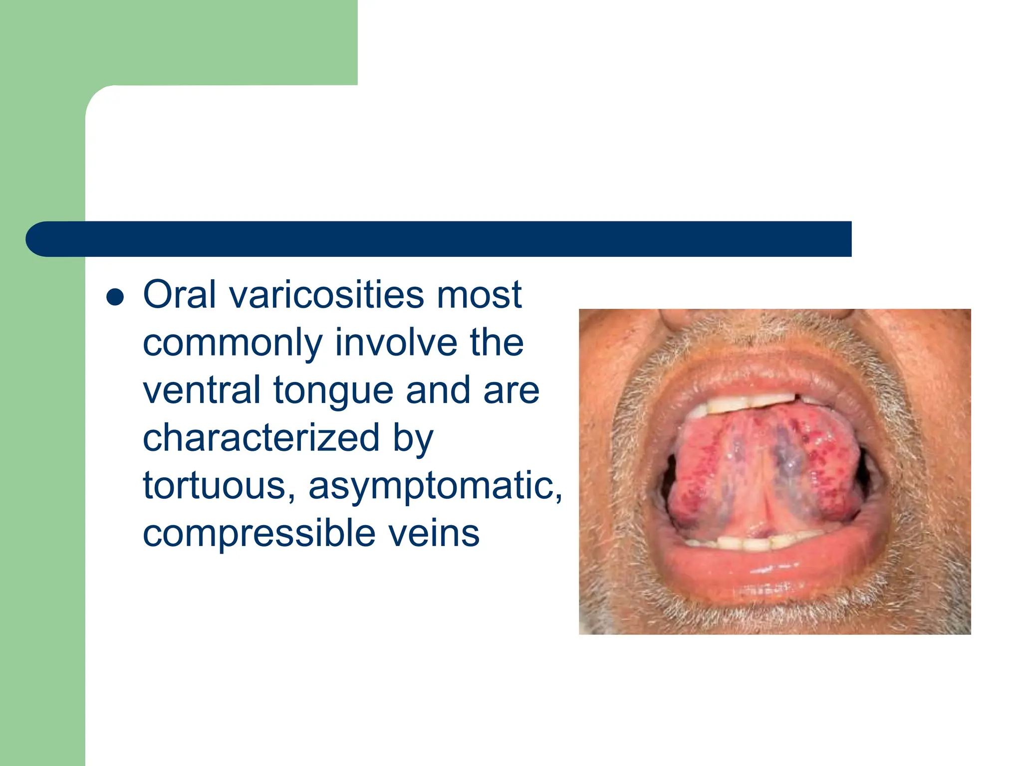  Oral varicosities most
commonly involve the
ventral tongue and are
characterized by
tortuous, asymptomatic,
compressible veins
 