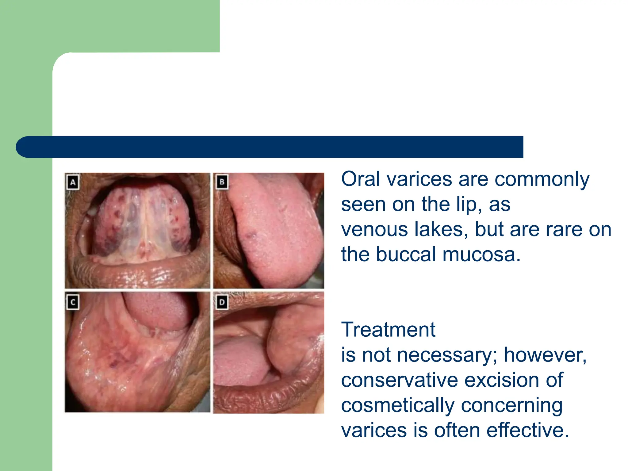 Oral varices are commonly
seen on the lip, as
venous lakes, but are rare on
the buccal mucosa.
Treatment
is not necessary; however,
conservative excision of
cosmetically concerning
varices is often effective.
 