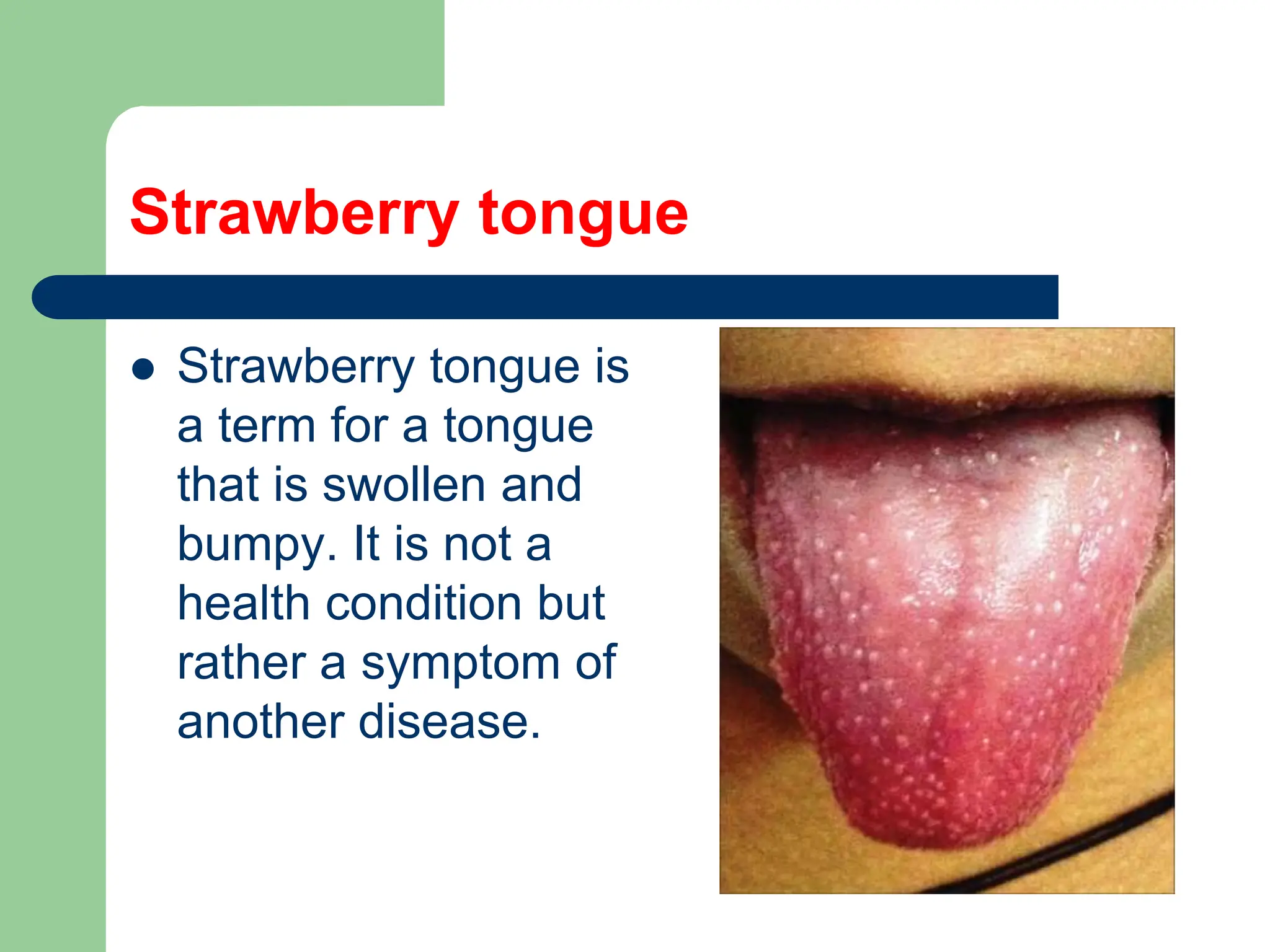 Strawberry tongue
 Strawberry tongue is
a term for a tongue
that is swollen and
bumpy. It is not a
health condition but
rather a symptom of
another disease.
 