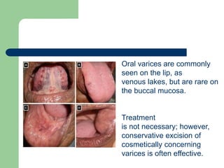 Oral varices are commonly
seen on the lip, as
venous lakes, but are rare on
the buccal mucosa.
Treatment
is not necessary; however,
conservative excision of
cosmetically concerning
varices is often effective.
 