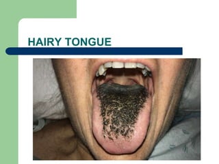 HAIRY TONGUE
 