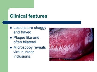 Clinical features
 Lesions are shaggy
and frayed
 Plaque like and
often bilateral
 Microscopy reveals
viral nuclear
inclusions
 