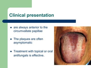 Clinical presentation
 are always anterior to the
circumvallate papillae
 The plaques are often
asymptomatic
 Treatment with topical or oral
antifungals is effective.
 