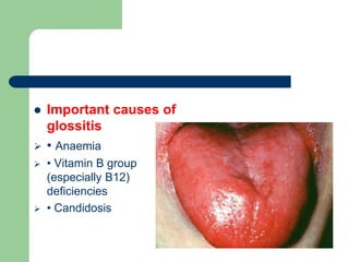  Important causes of
glossitis
 • Anaemia
 • Vitamin B group
(especially B12)
deficiencies
 • Candidosis
 