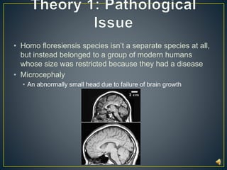 • Homo floresiensis species isn’t a separate species at all, 
but instead belonged to a group of modern humans 
whose size was restricted because they had a disease 
• Microcephaly 
• An abnormally small head due to failure of brain growth 
 