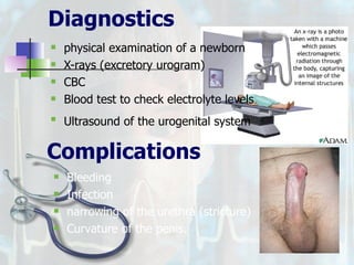 Diagnostics physical examination of a newborn X-rays (excretory urogram) CBC Blood test to check electrolyte levels  Ultrasound of the urogenital system   Complications Bleeding Infection narrowing of the urethra (stricture) Curvature of the penis. 