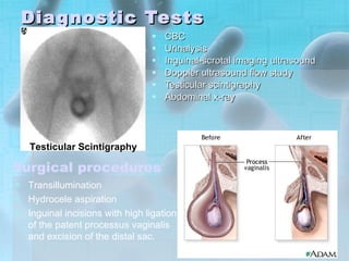 Diagnostic Tests CBC Urinalysis Inguinal-scrotal imaging ultrasound  Doppler ultrasound flow study  Testicular scintigraphy  Abdominal x-ray Testicular Scintigraphy Surgical procedures Transillumination  Hydrocele aspiration  Inguinal incisions with high ligation of the patent processus vaginalis and excision of the distal sac. 