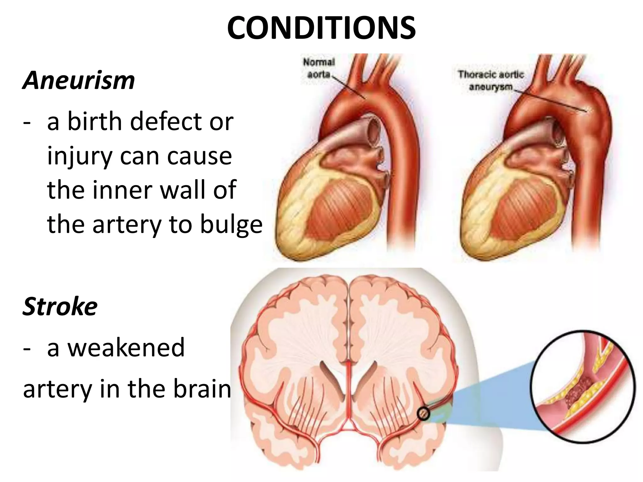 CONDITIONS
Aneurism
- a birth defect or
injury can cause
the inner wall of
the artery to bulge
Stroke
- a weakened
artery in the brain
 