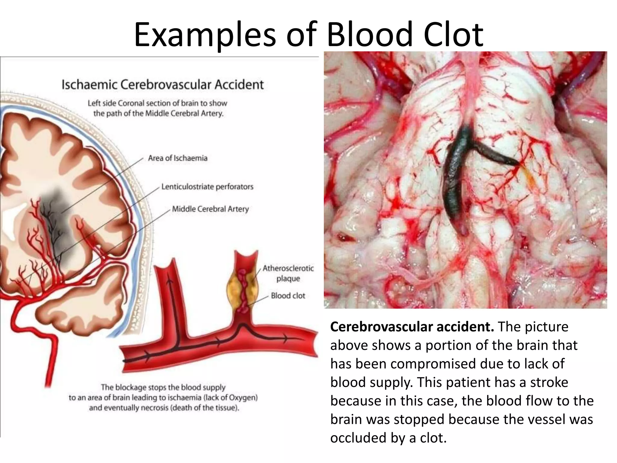 Examples of Blood Clot
Cerebrovascular accident. The picture
above shows a portion of the brain that
has been compromised due to lack of
blood supply. This patient has a stroke
because in this case, the blood flow to the
brain was stopped because the vessel was
occluded by a clot.
 