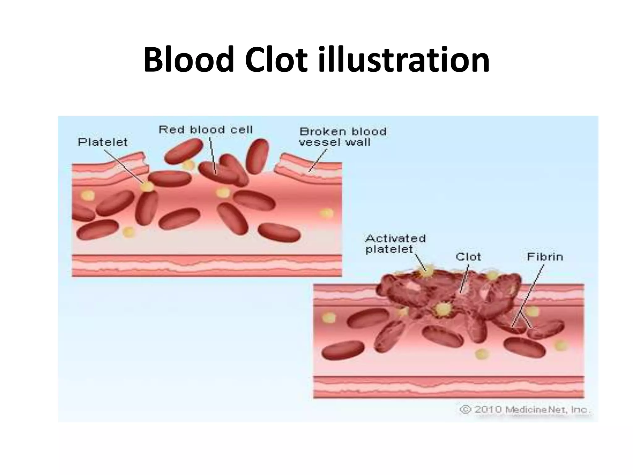 Blood Clot illustration
 
