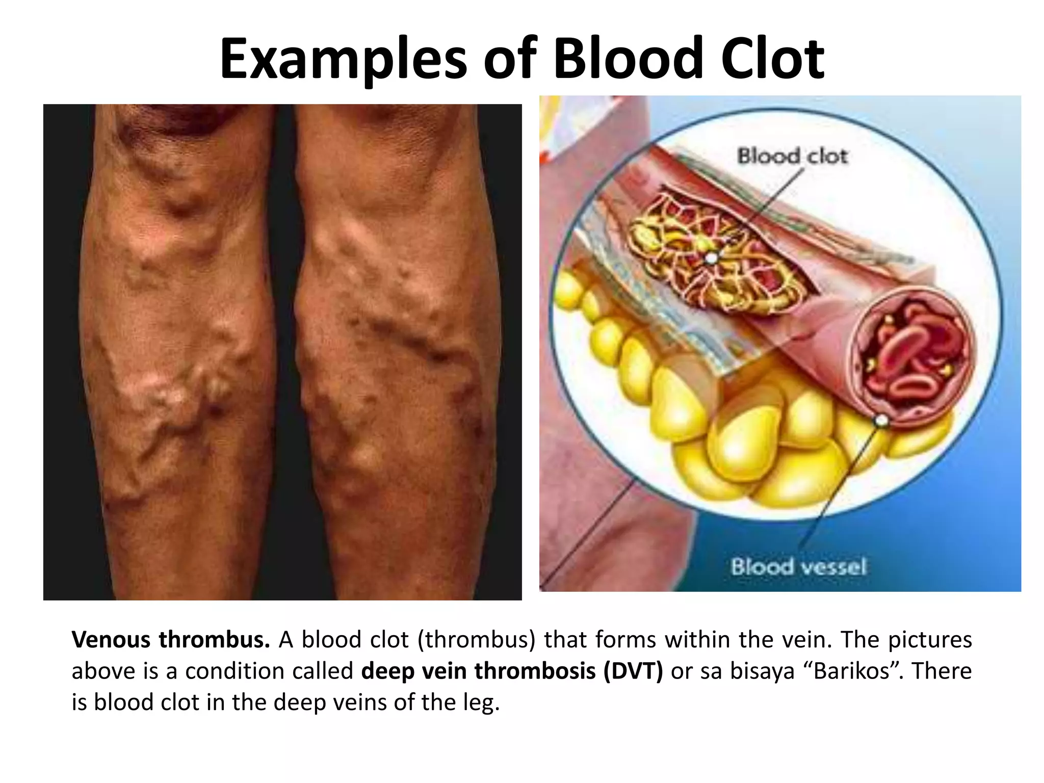 Examples of Blood Clot
Venous thrombus. A blood clot (thrombus) that forms within the vein. The pictures
above is a condition called deep vein thrombosis (DVT) or sa bisaya “Barikos”. There
is blood clot in the deep veins of the leg.
 