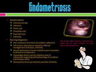 Complications Internal scarring Adhesion Pelvic cyst Chocolate cyst Rupruted cyst Infertility  Nursing Diagnosis Pain related to hormonal stimulation, adhesions Self esteem disturbance related to difficult management of disease, infertility Sexual dysfunction may be related to pain secondary to presence of adhesions  Knowledge deficit may be related to lack of information regarding pathophysiology of condition and therapy needs. Anticipatory Grieving related to possible infertility This picture above shows a chocolate cyst, which can be quite common in more advanced endometriosis. 