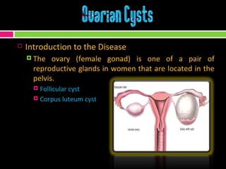 Introduction to the Disease The ovary (female gonad) is one of a pair of reproductive glands in women that are located in the pelvis. Follicular cyst Corpus luteum cyst 