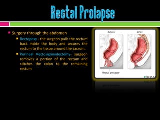 Surgery through the abdomen  Rectopexy  - the surgeon pulls the rectum back inside the body and secures the rectum to the tissue around the sacrum. Perineal Rectosigmoidectomy - surgeon removes a portion of the rectum and stitches the colon to the remaining rectum 