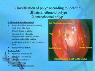 Classification of polyp according to location
                1.Bilateral ethmoid polypi
                   2.antrochoanal polyp
1.Bilateral Ethmoidal polypi
• Bilateral,multiple in number,usually
    small grape like mass
•    Usually found in adults.
• Originate from ethmoidal
    sinuses,uncinate process, middle
    turbinate and middle meatus
• Mostly grow anteriorly may present at
    nares
• Reoccurence common
ETIOLOGY:
• A)chronic rhinosinusitis
• B)Asthma (risk factor)
• C)Asprin intolerence
• D)cystic fibrosis
• E)Allergic fungal sinusitus
 