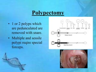 Polypectomy
• 1 or 2 polyps which
  are pedunculated are
  removed with snare.
• Multiple and sessile
  polypi reqire special
  forceps.
 